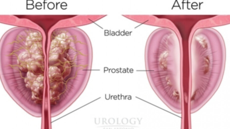 The right BPH treatment for you?