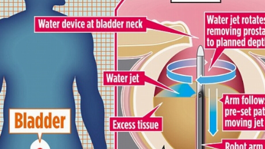 NICE Approval for Aquabeam treatment for BPH