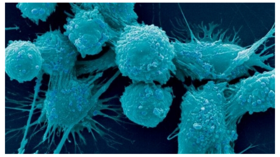 Genetic test tells patient if prostate cancer is likely to spread